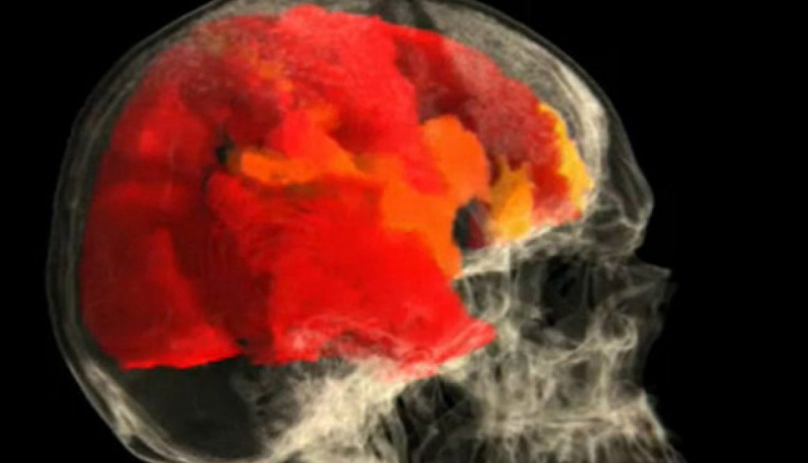 imagen de resonancia magnetica del cerebro de una mujer durante un orgasmo